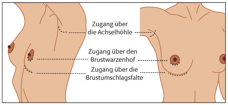 Schnittführungen bei der Brustvergrößerung